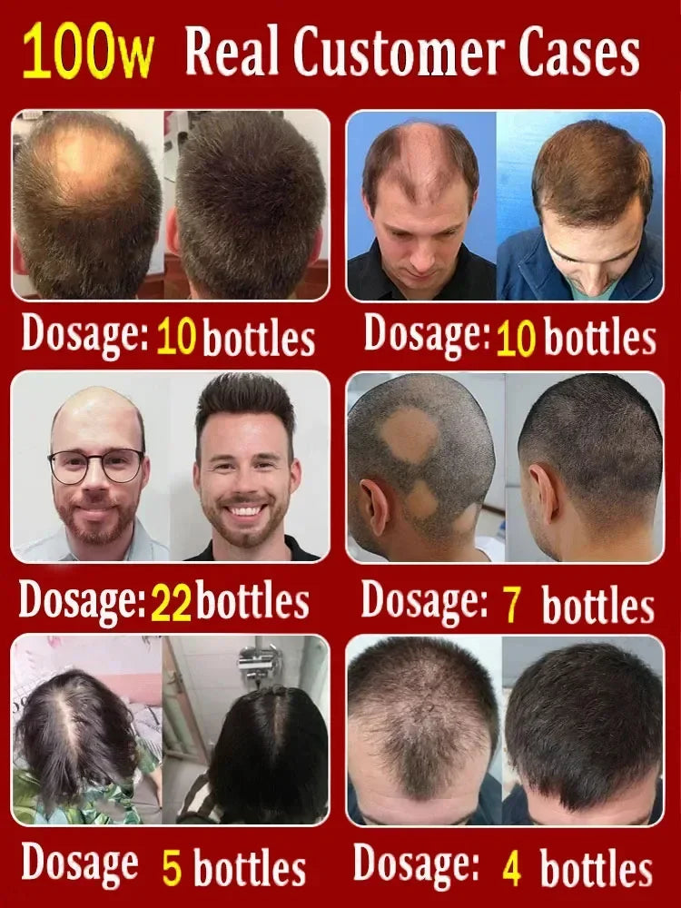 Hot selling product, 99% of buyers buy again, have more and more hair, say goodbye to baldness, thick hair